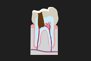 Болят десна и зубы после удаления нерва thumbnail