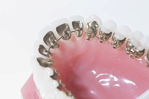 Лечение прикуса брекетами с удалением зубов thumbnail