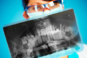 Рентгеновский снимок зуба до лечения и после thumbnail