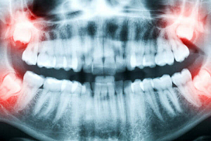 Восстановление костной ткани зубов лечение thumbnail