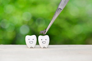 Лечение межзубного кариеса передних зубов thumbnail