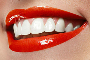 Пластика десны передних зубов