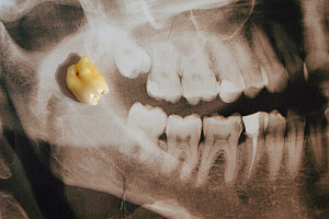 Особенности при лечении зубов мудрости thumbnail