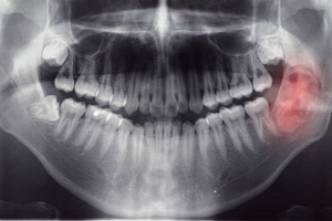 Временное лечение каналов зуба thumbnail