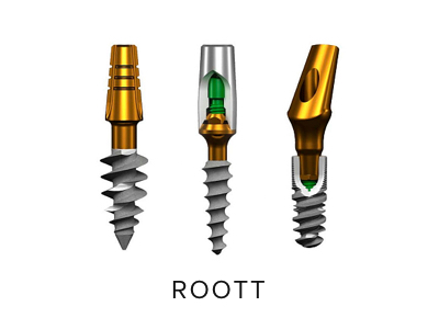 Roott имплантация – вся правда о возможных рисках