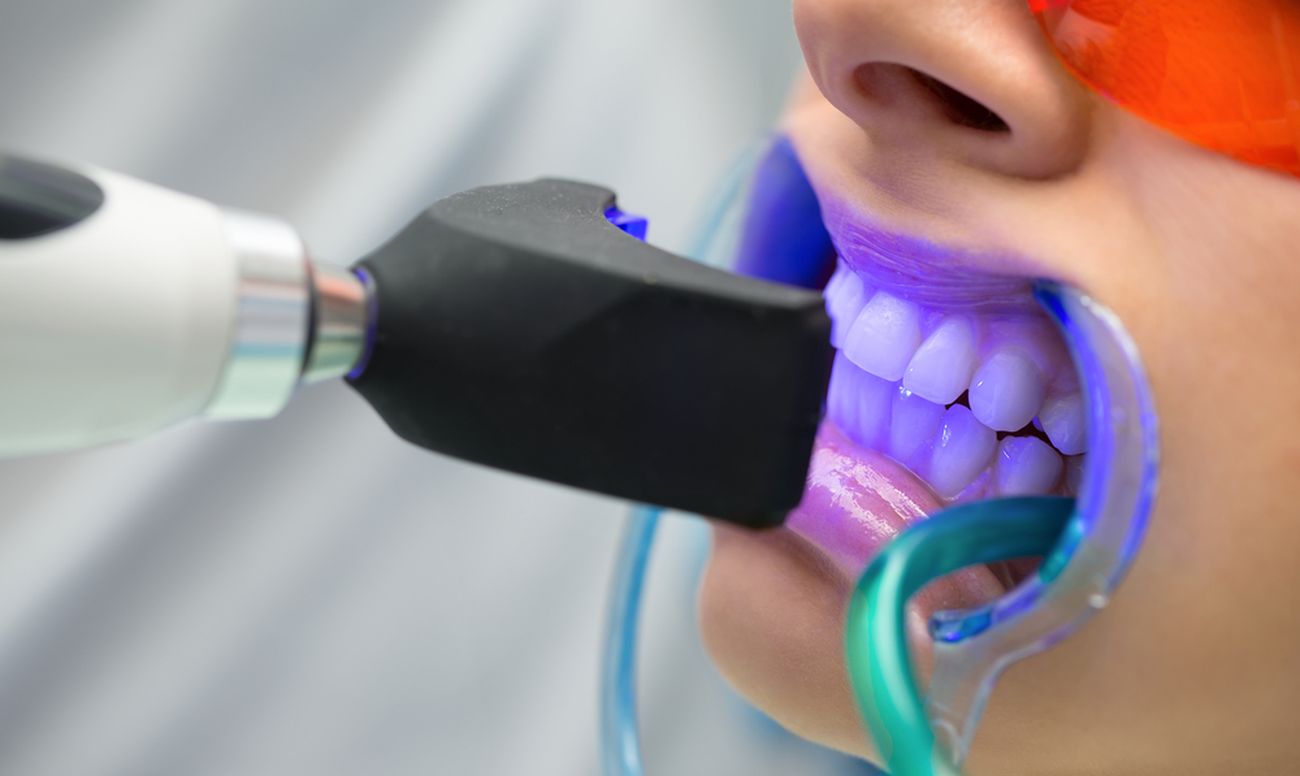 Технологии отбеливания зубов могут быть опасны