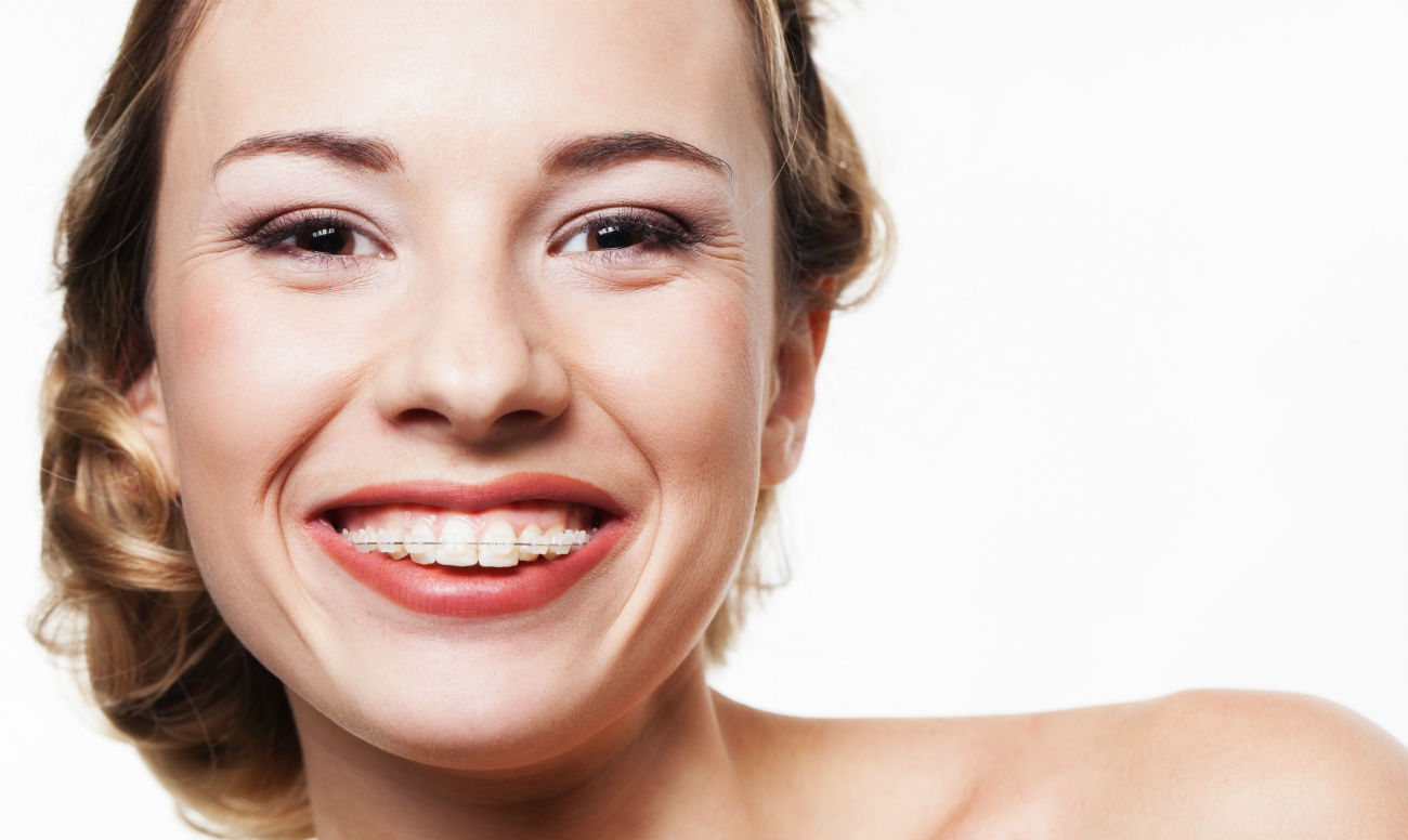 Керамические брекеты — установка брекет-системы из керамики, фиксация ...