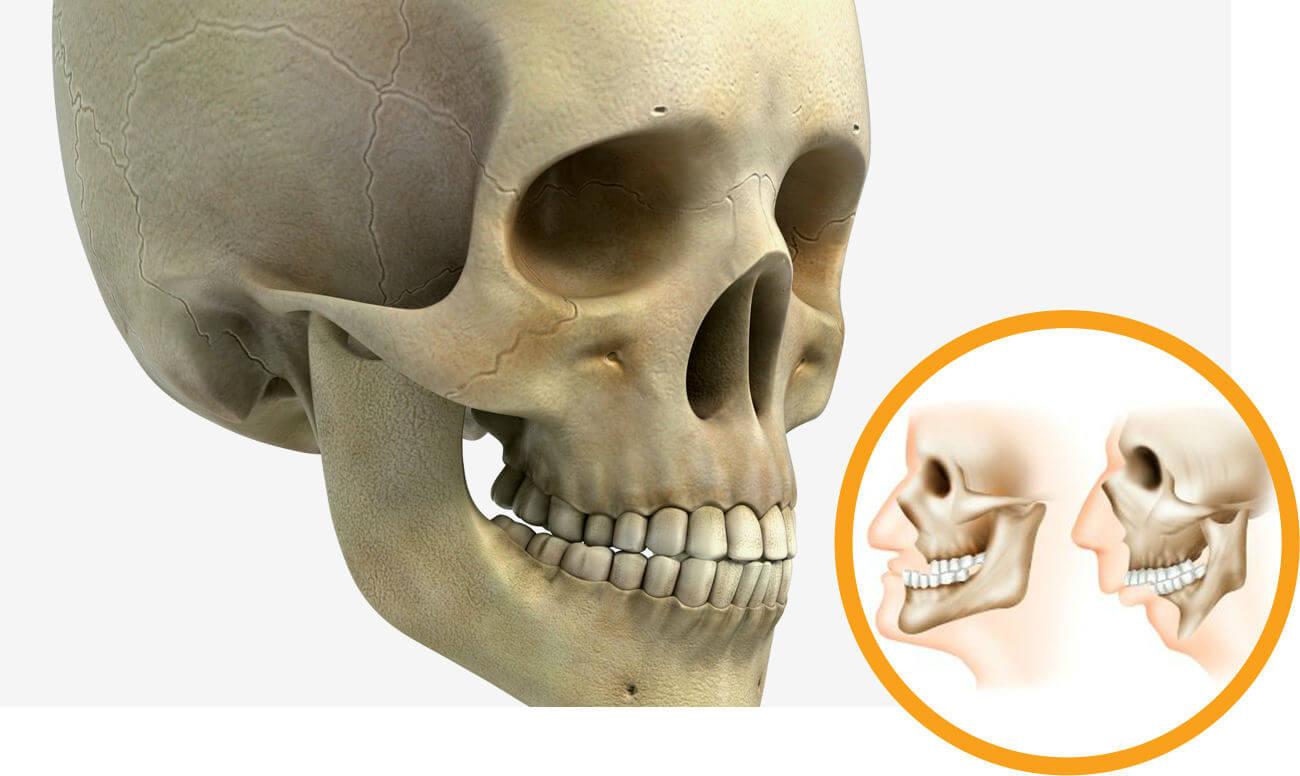 Нижняя челюсть с черепом подвижные. Микрогнатия нижней челюсти. Микрогнатия верхней челюсти. Микрогнатия недоразвитие нижней челюсти.