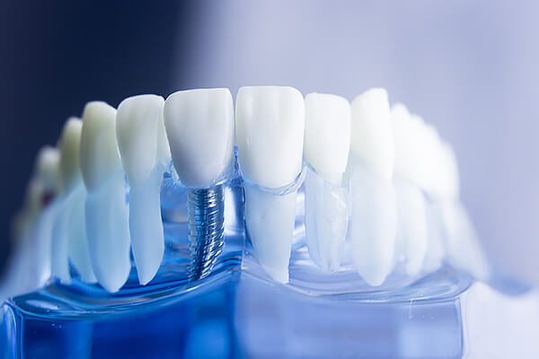 Как приживаются зубные импланты?