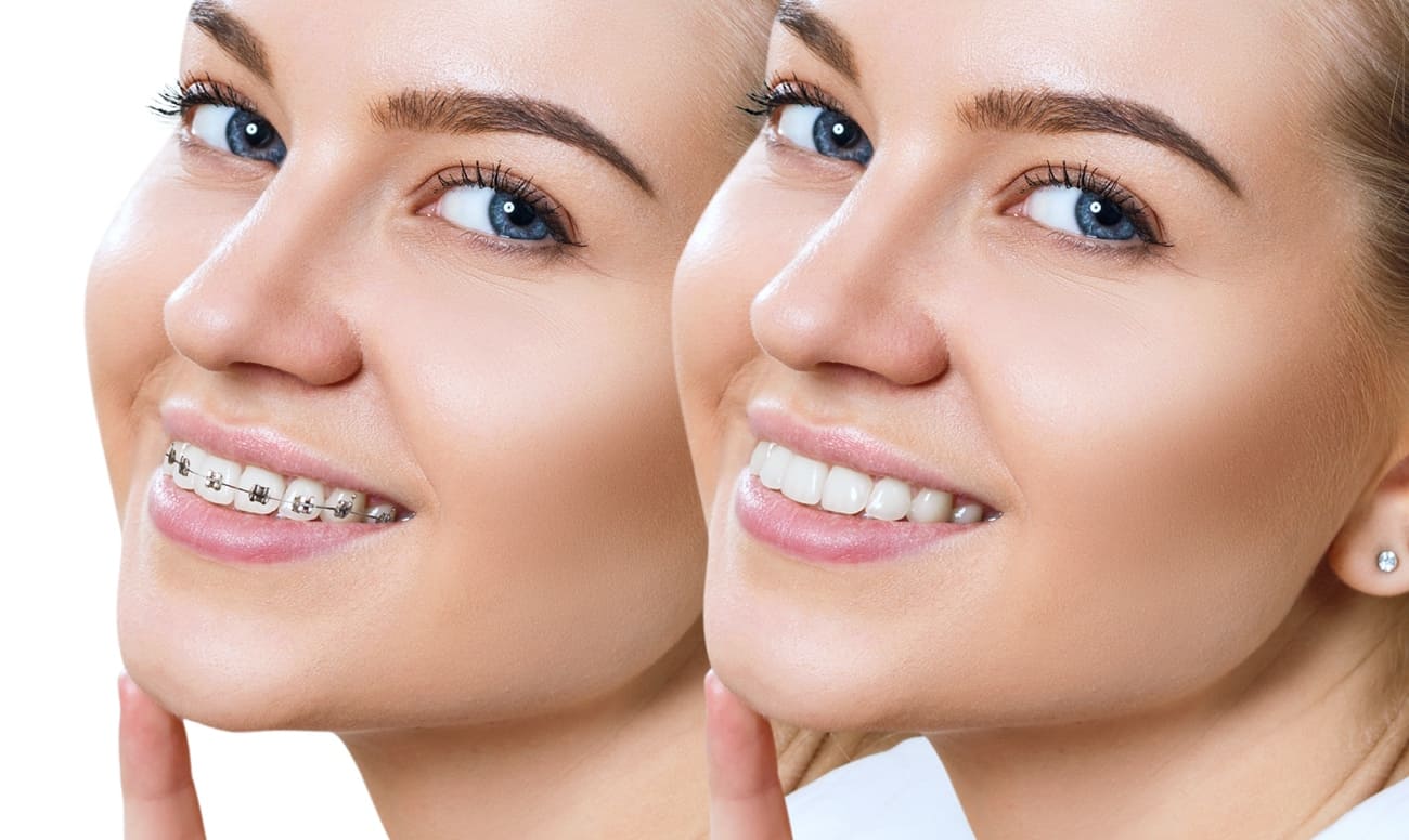 Какие лучше брекеты ставить — советы по выбору брекет-системы на ...