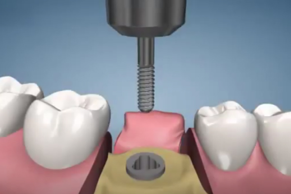 Как устанавливают имплант жевательного зуба