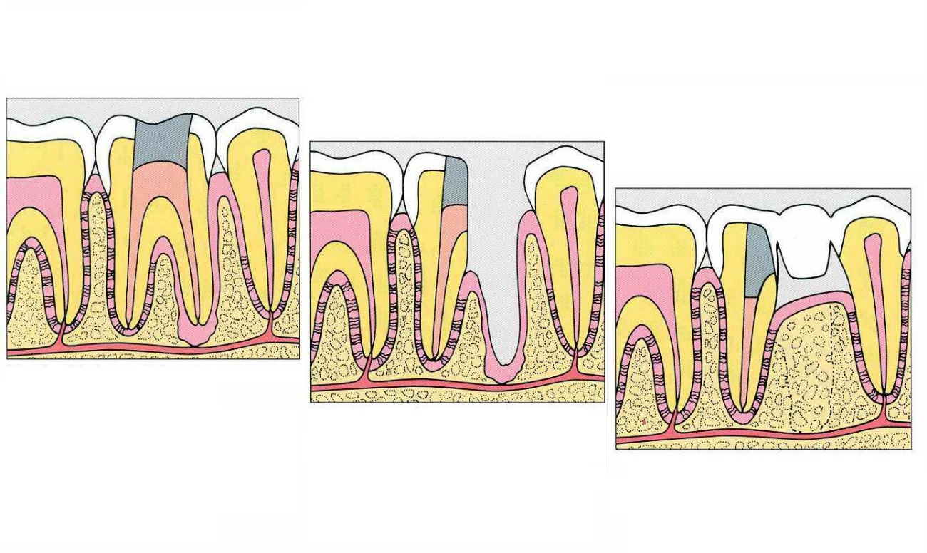 Зубосохраняющая операция. Гемисекция коронорадикулярная сепарация. Гемисекция и ампутация корня зуба. Коронарно-радикулярная сепарация.