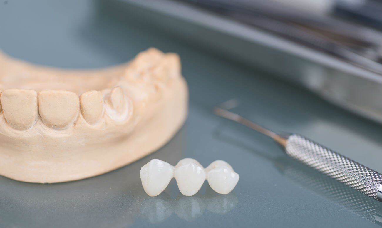 Слепок зуба — что это такое, как изготавливают — Startsmile