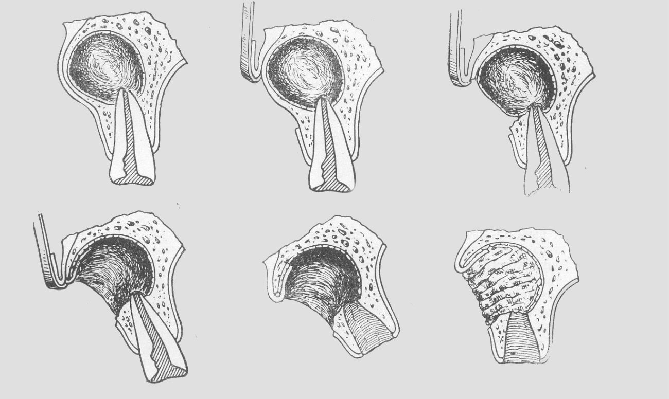 Цистотомия и цистэктомия. ОРОНАЗАЛЬНАЯ цистотомия. Цистотомия радикулярной кисты. Цистотомия и цистэктомия в стоматологии