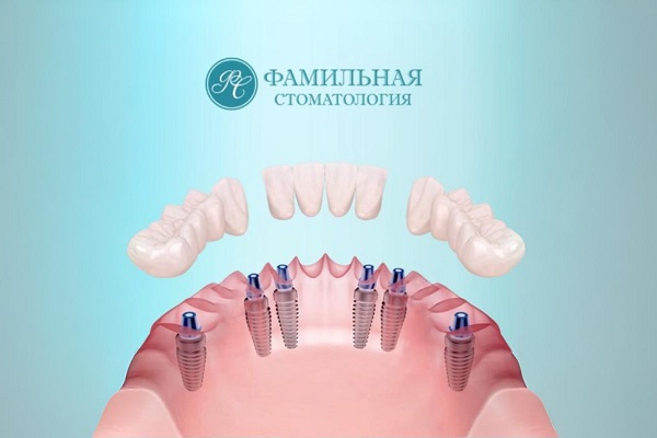 Полное протезирование челюсти на имплантах на трех циркониевых мостах
