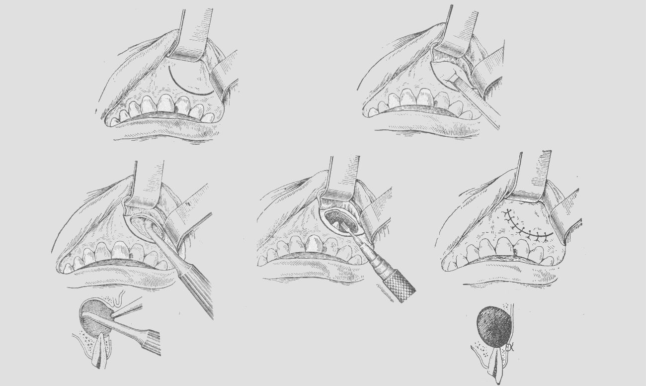 Операция нижней губы. Цистотомия цистэктомия цистотомия. Цистэктомия с резекцией верхушки корня. Цистэктомия верхней челюсти. Операция резекции верхушки корня зуба.