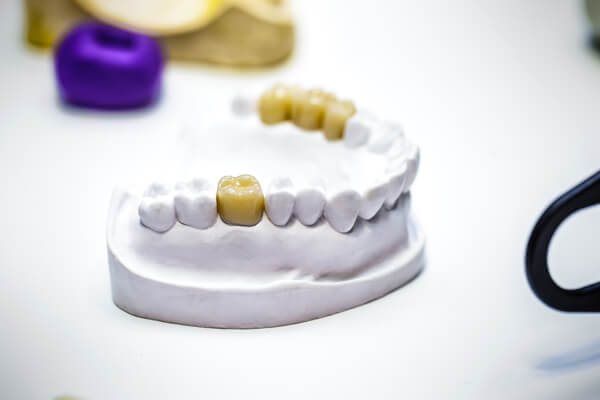 Какую коронку выбрать на жевательный зуб?