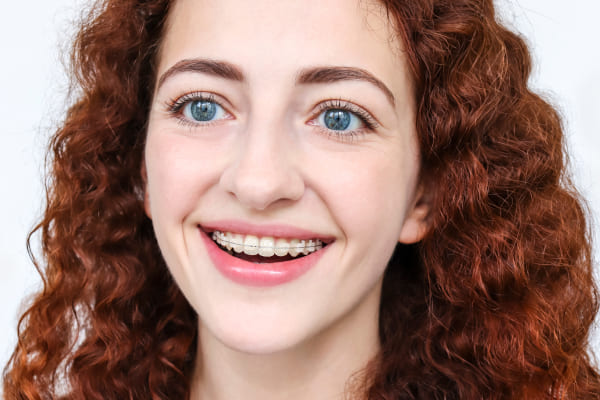 Брекеты на зубы — для чего нужны, стоит ли ставить, фото до и после ...