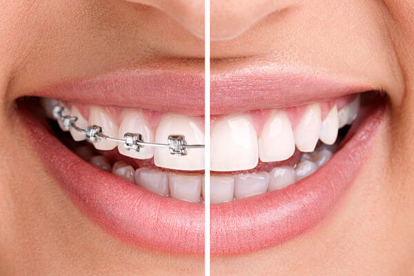 Брекеты на зубы — для чего нужны, стоит ли ставить, фото до и после ...