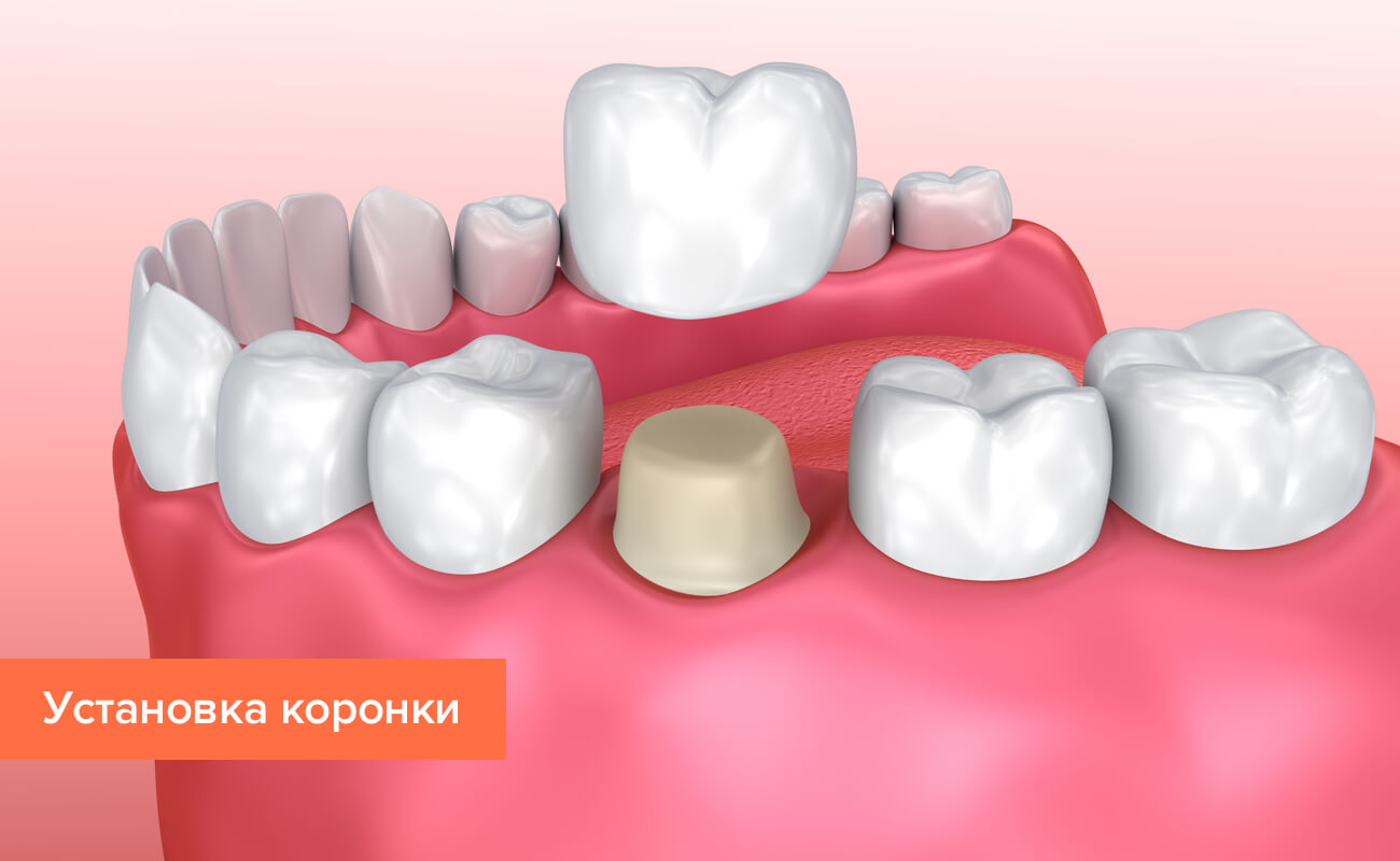 Графика установки коронки Графика установки коронки