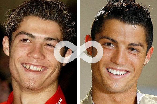 Фото кривых зубов Криштиану Роналду до и после лечения