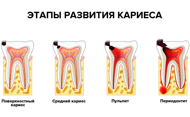 Этапы развития кариеса в картинках