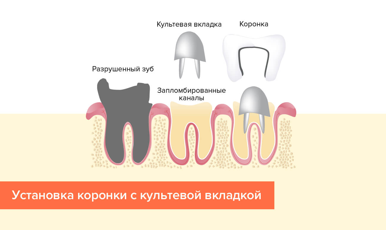 Коронка на передний зуб схема