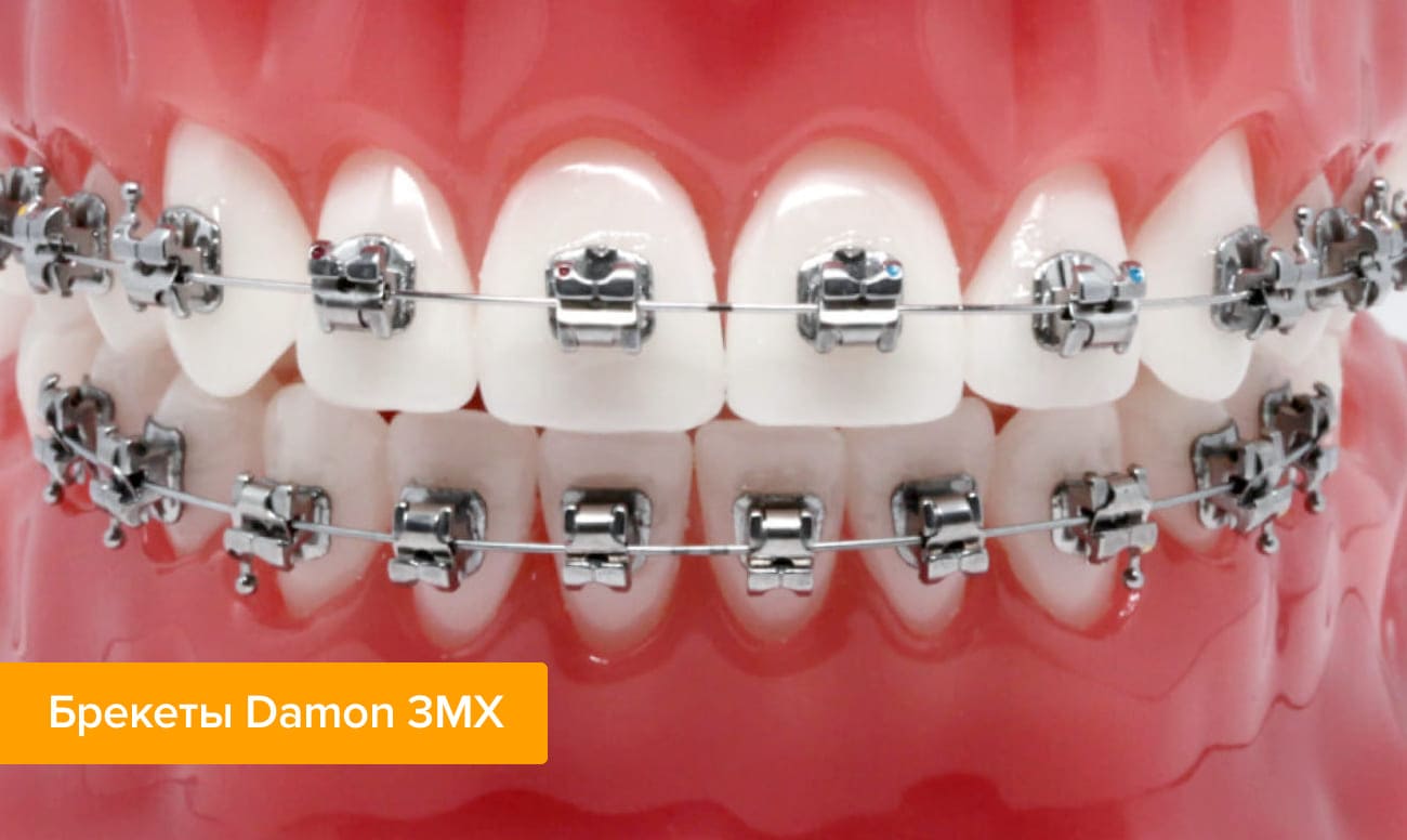 Брекеты Damon 3MX Фото брекетов Damon 3MX на зубах