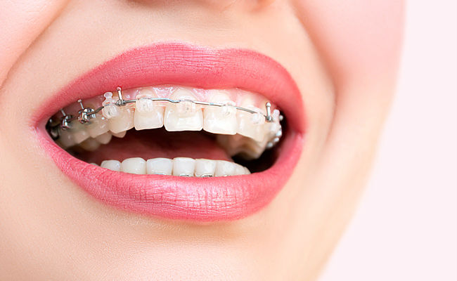 Эстетические брекеты на зубах