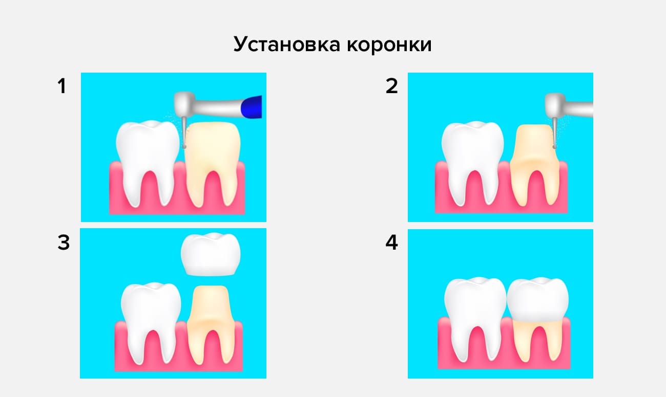 Установка коронки Установка коронки в картинках