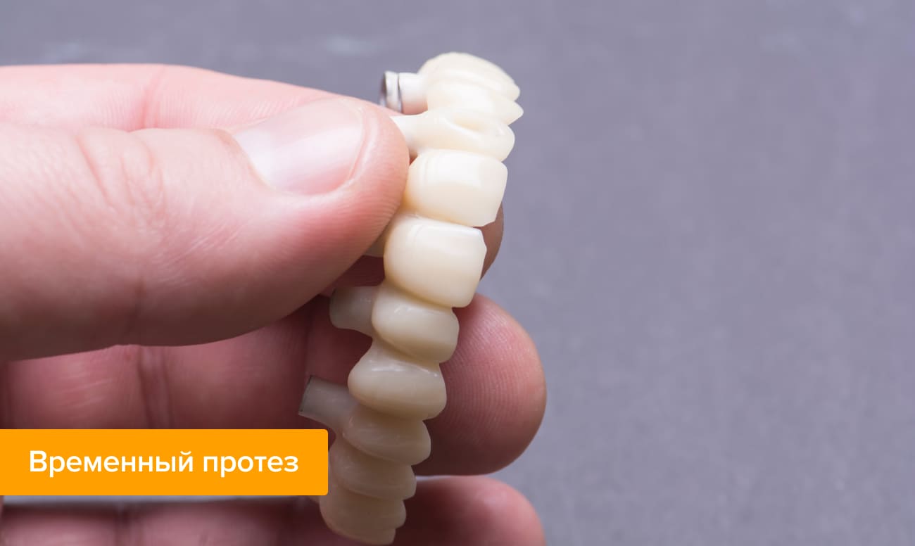 Для чего нужны временные коронки при имплантации. Смотреть фото Для чего нужны временные коронки при имплантации. Смотреть картинку Для чего нужны временные коронки при имплантации. Картинка про Для чего нужны временные коронки при имплантации. Фото Для чего нужны временные коронки при имплантации
