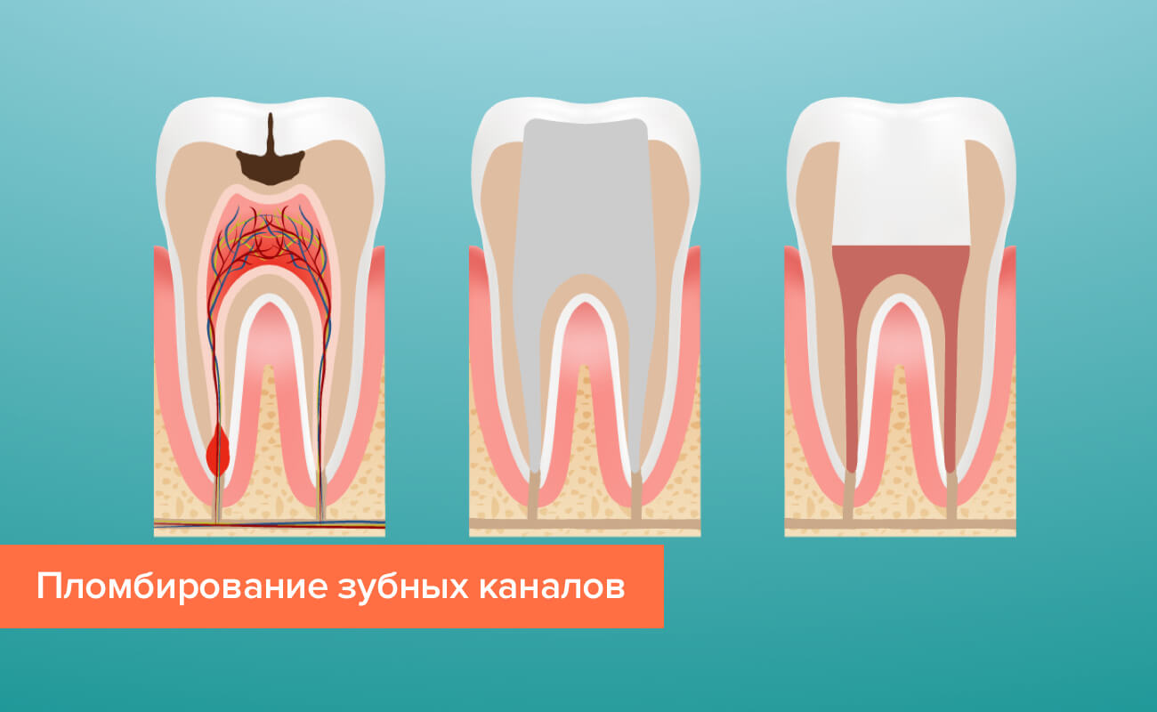 Пломбирование зубных каналов в картинках