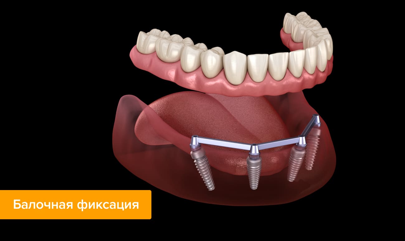 Балочная фиксация протеза в картинках
