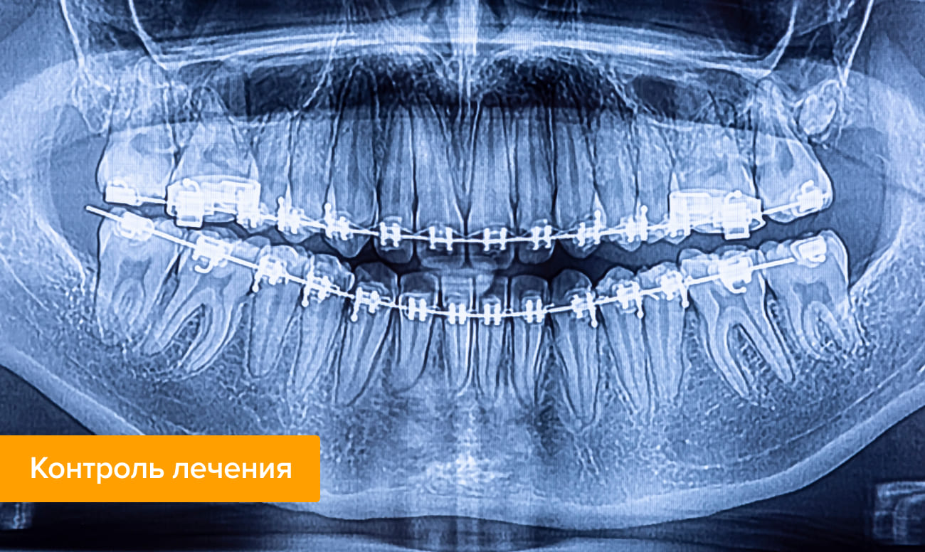 Рентген зубов с брекетами