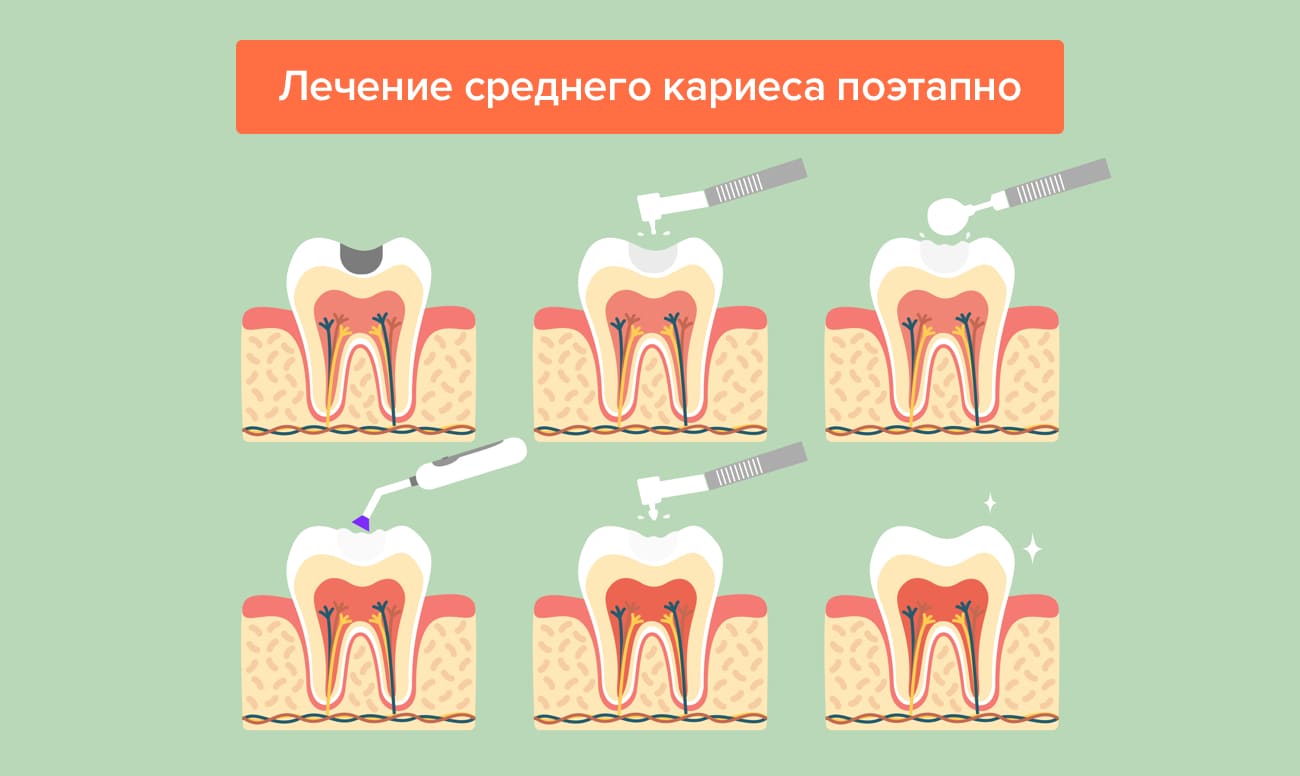 Лечение кариеса: почему это так важно?