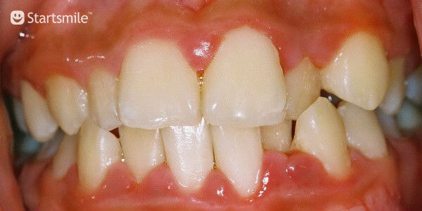 Гингивит у взрослых – симптомы, фото, отзывы