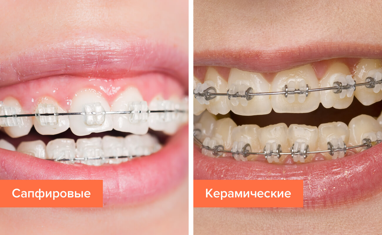 Фото сапфировых и керамических брекетов на зубах