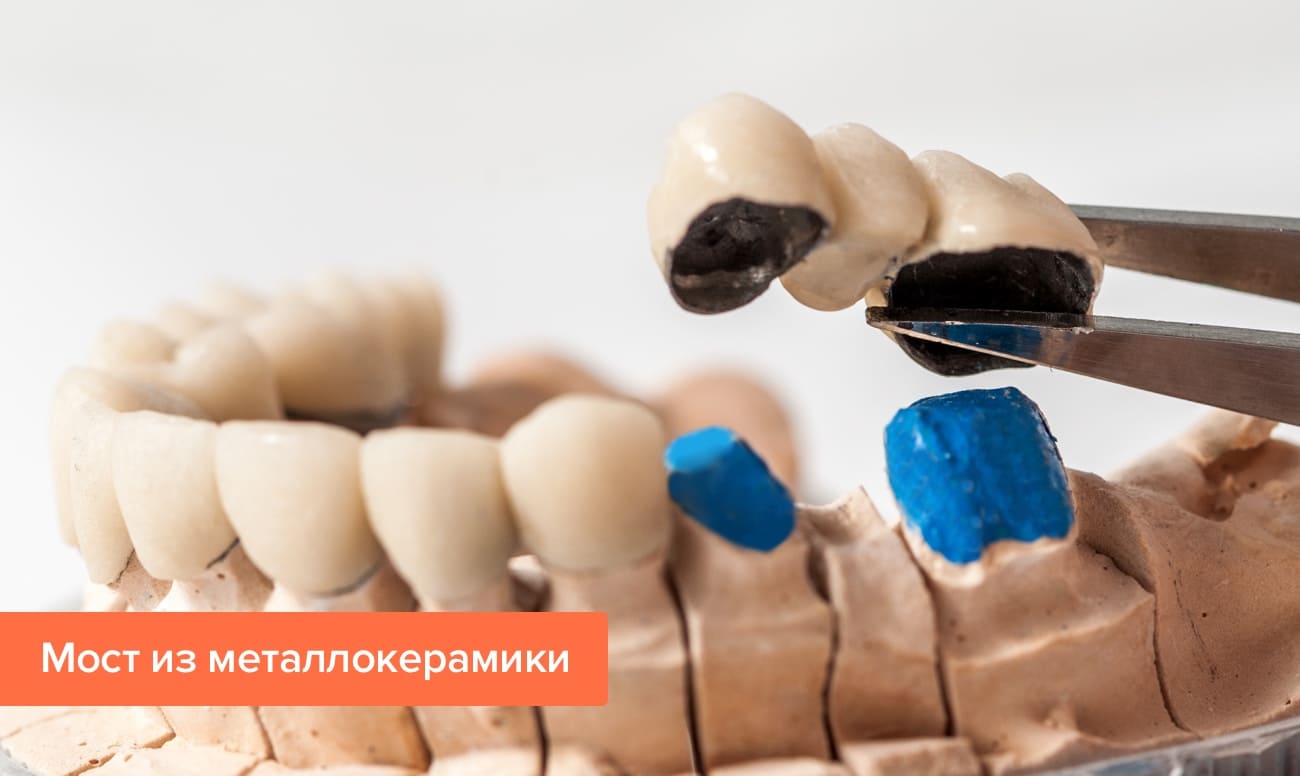 Мостовидный протез