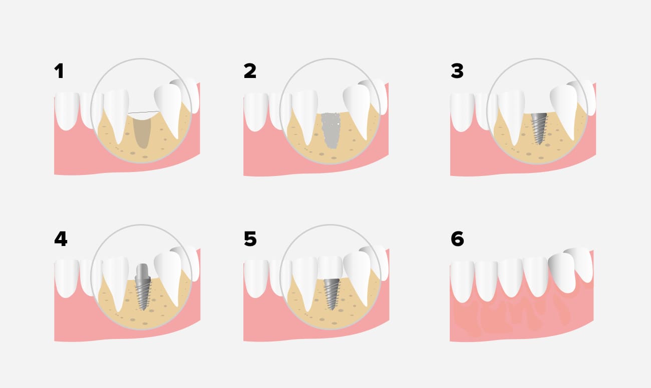 Порядок установки имплантов зубов в картинках