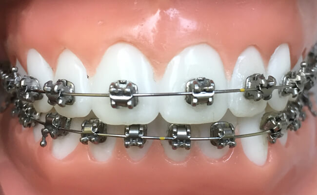 Брекеты Dentsply In-Ovation R на зубах Фото брекетов Dentsply In-Ovation R на зубах