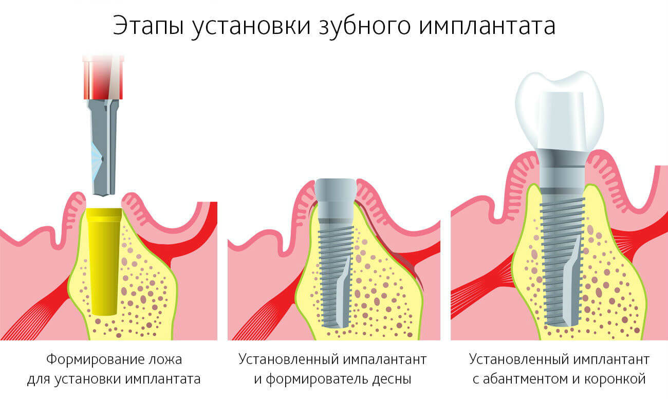 Имплантация зубов - основные этапы