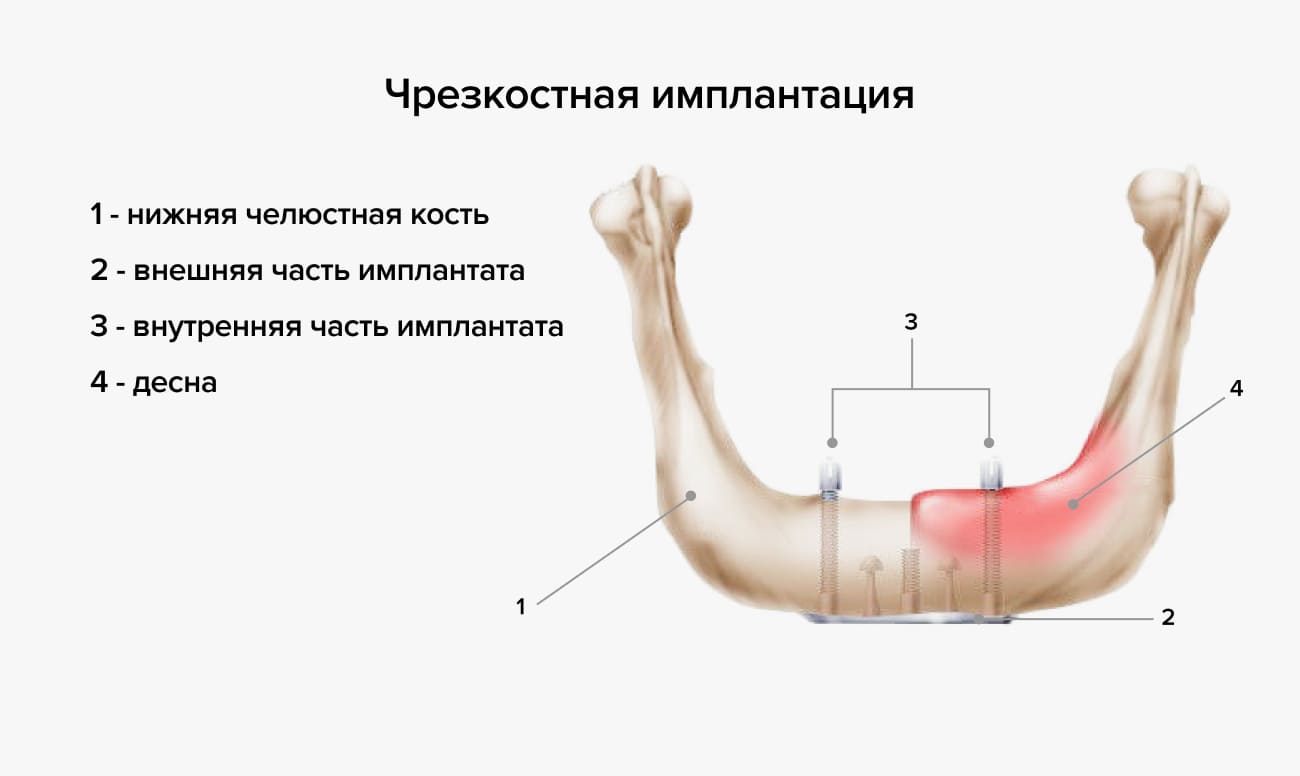 Чрезкостная имплантация в картинках