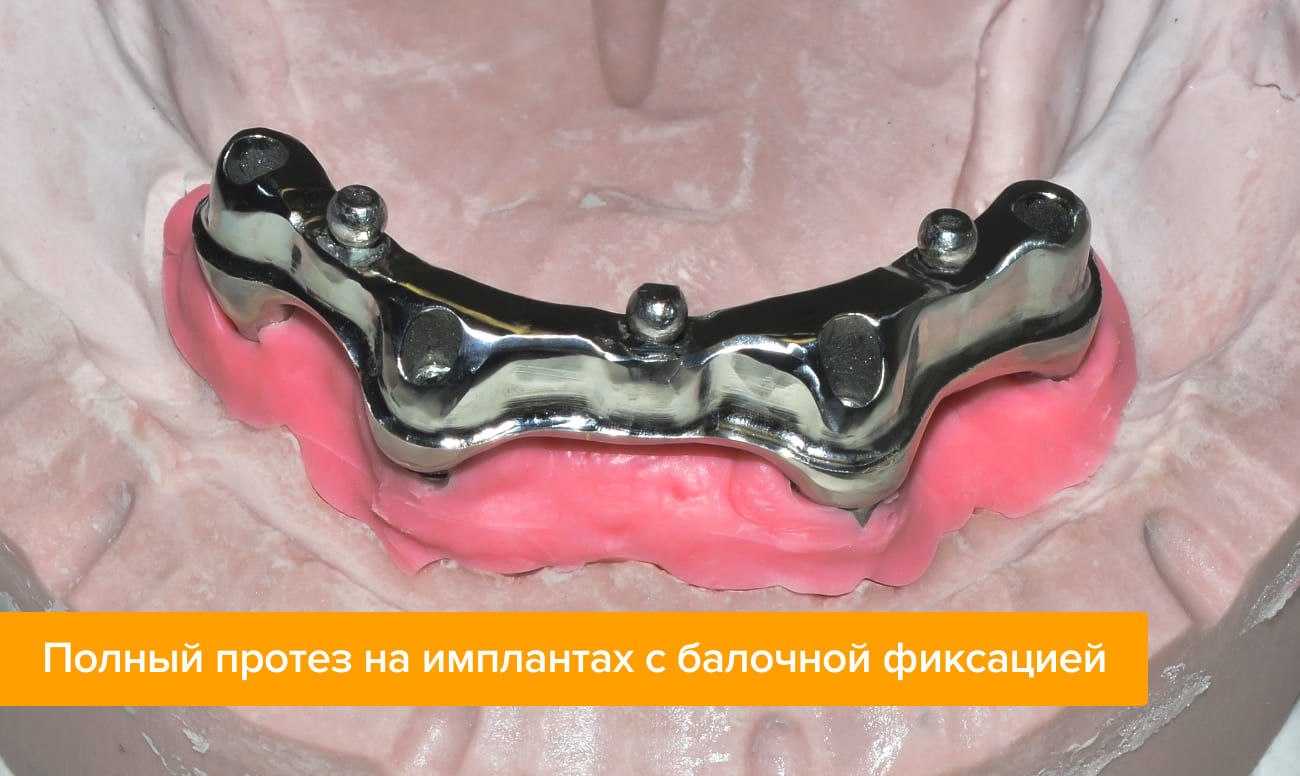 Полный протез на имплантах с балочной фиксацией Фото полного протеза на имплантах с балочной фиксацией