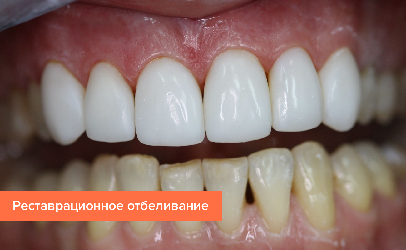 Фото после реставрационного отбеливания Фото пациента после реставрационного отбеливания