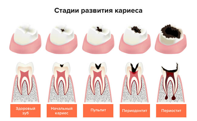 Различные стадии кариеса в картинках