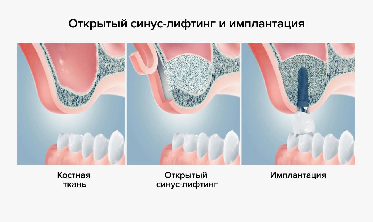 Остеопластические материалы в стоматологии презентация