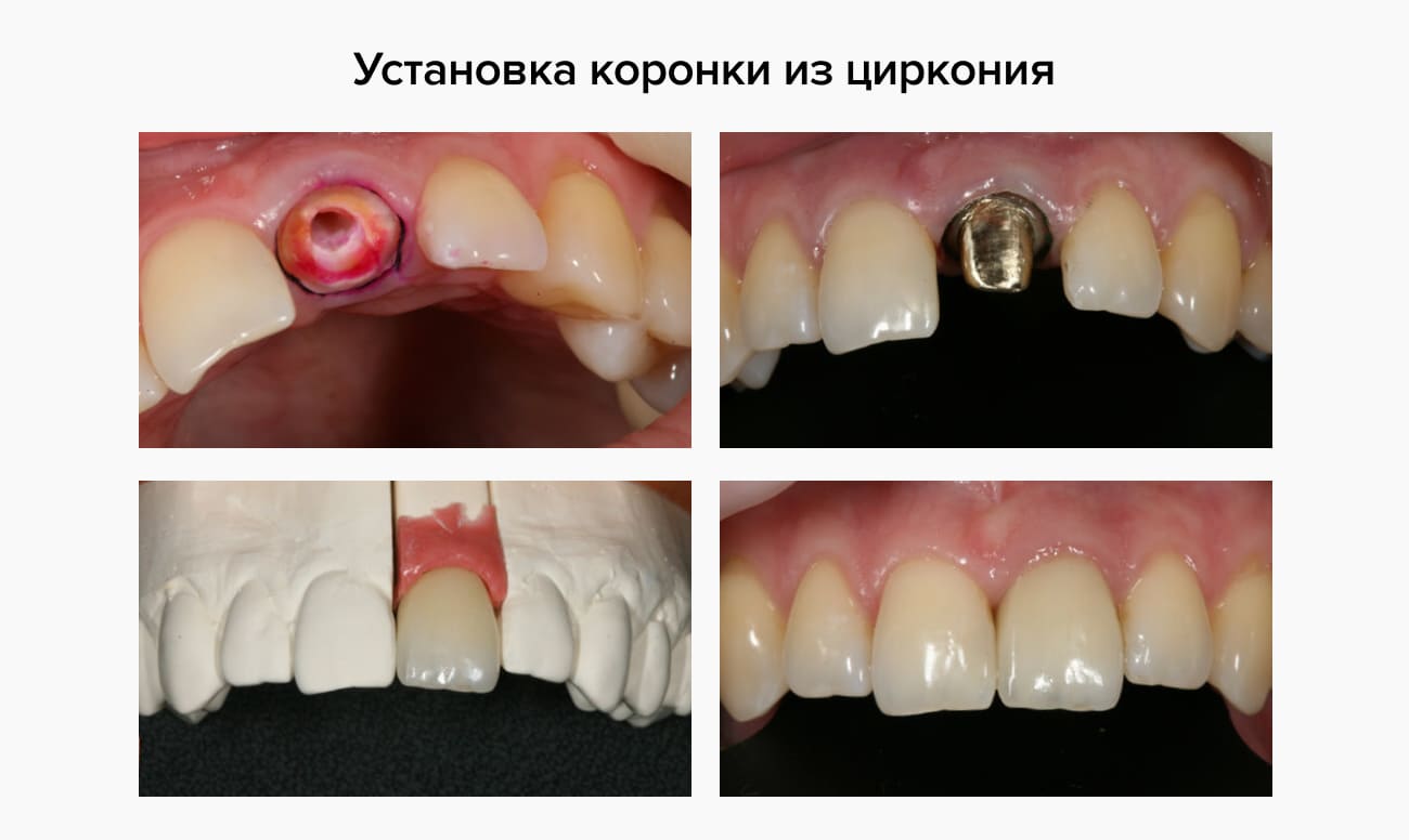 Этапы установки циркониевой коронки