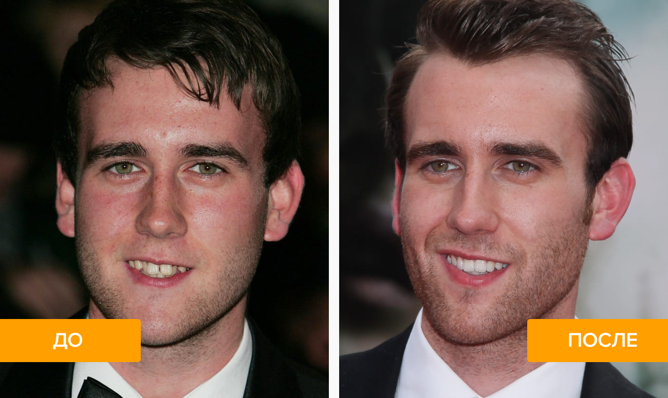 Фото кривых зубов Мэттью Льюиса до и после лечения