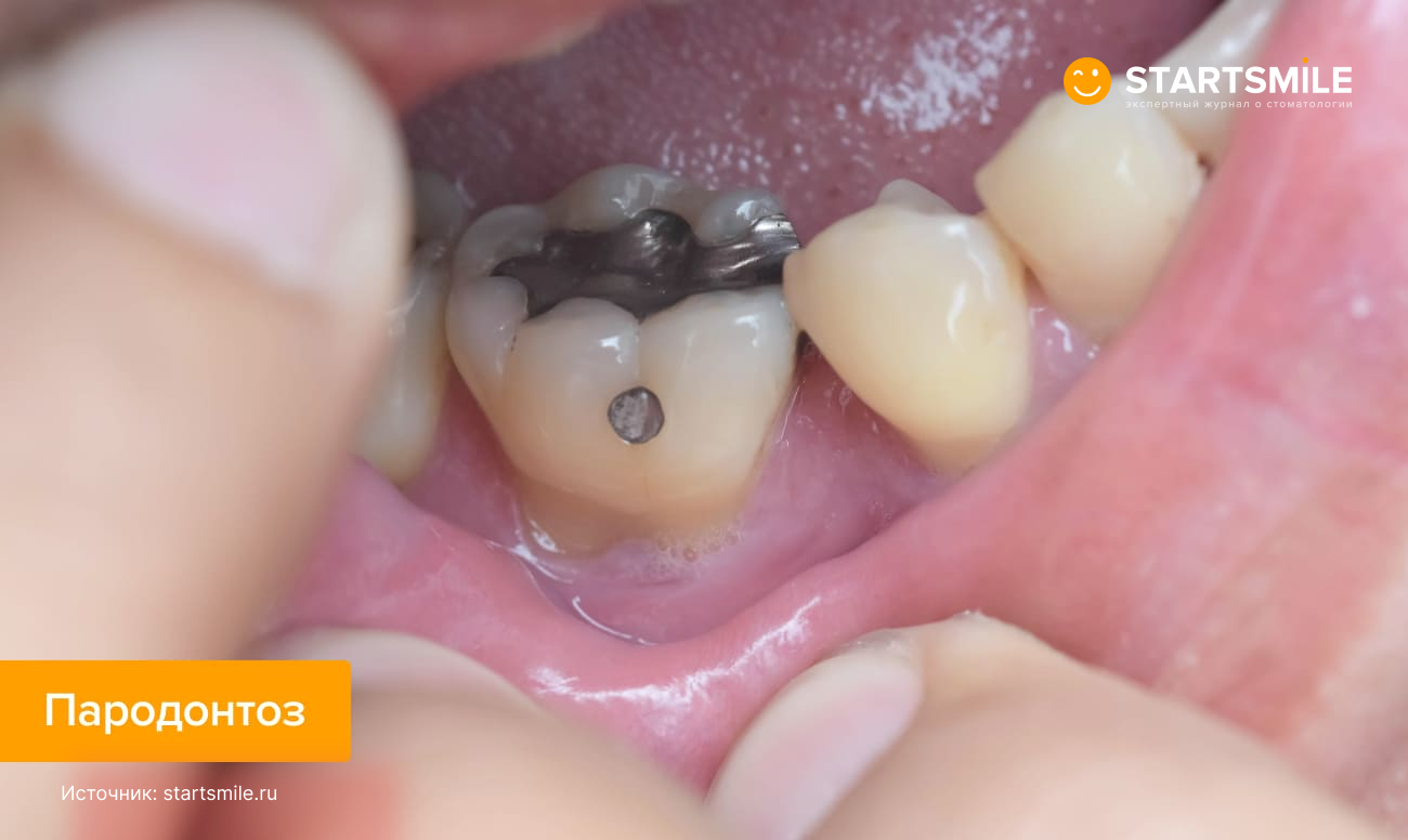 Фото оголения корня зуба вследствие пародонтоза.