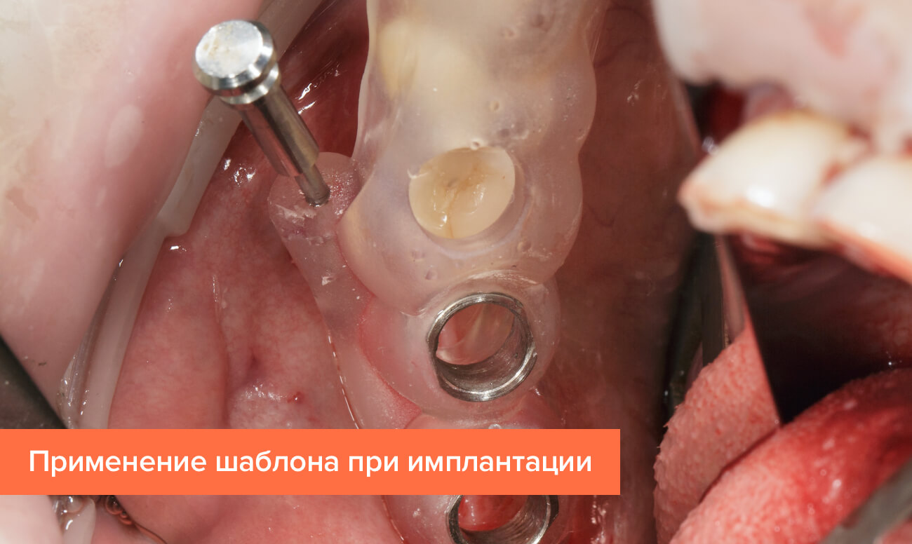 Фото применения хирургического шаблона при операции по имплантации зубов.